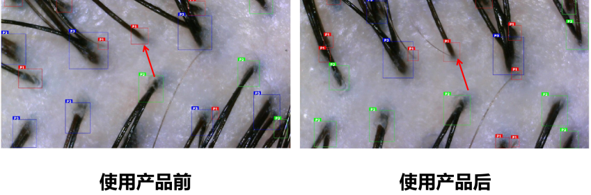 頭皮健康,紅斑,,丘疹,膿皰,評(píng)價(jià)方法