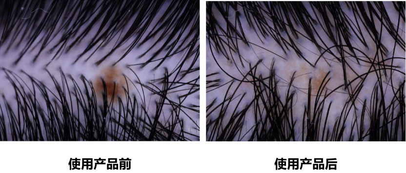 頭皮健康,紅斑,,丘疹,膿皰,評(píng)價(jià)方法