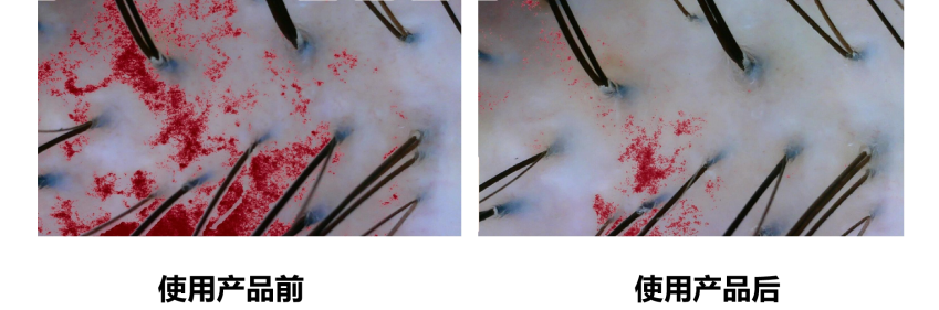 頭皮健康,紅斑,,丘疹,膿皰,評(píng)價(jià)方法