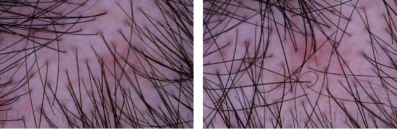 頭皮健康,紅斑,,丘疹,膿皰,評(píng)價(jià)方法